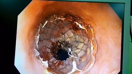 95% biểu hiện khó nuốt là ung thư thực quản.