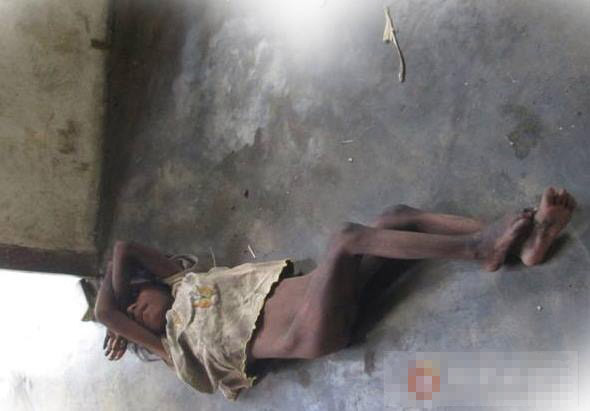 Cô bé "người rừng" Mấu Thị Ni trong tình trạng báo động về thể chất và tinh thần khi được phát hiện. người rừng