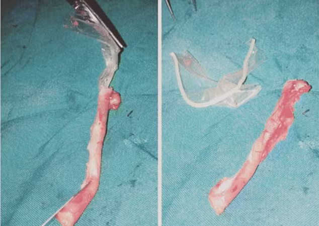 Bất ngờ phát hiện bao cao su trong ruột thừa của nữ bệnh nhân