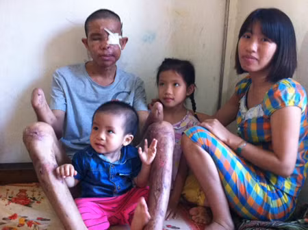 Anh Hảo mất đôi bàn tay, đôi mắt, gia đình mất đi trụ cột kinh tế và lâm vào cảnh khánh kiệt.