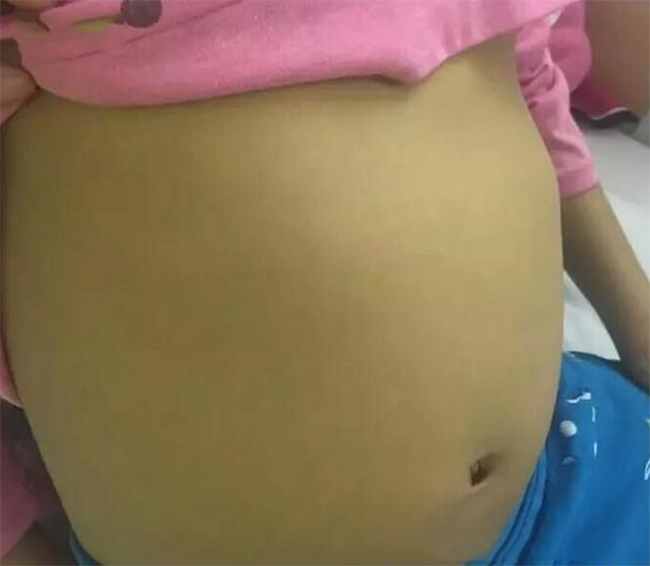 Chỉ sau 6 tháng ăn đồ ăn nhanh, Nana đã bị viêm gan với bụng phình to (Ảnh minh họa)