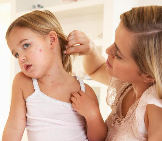 Dấu hiệu, triệu chứng và cách điều trị bệnh thủy đậu cho cả người lớn và trẻ em - Ảnh 4