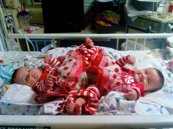 Tách rời thành công ca song sinh dính liền cực hiếm, chỉ 1 trên 50 triệu ca sinh