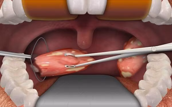 Bé gái 7 tuổi tử vong chỉ sau vài phút phẫu thuật cắt amidan, chuyên gia đưa ra một loạt cảnh báo-5