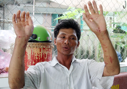 Thuyền trưởng Cường với hay cánh tay chằng chịt vết cắt do vật lộn với sóng và đeo bám lên chòi đáy. Ảnh: An Nhơn