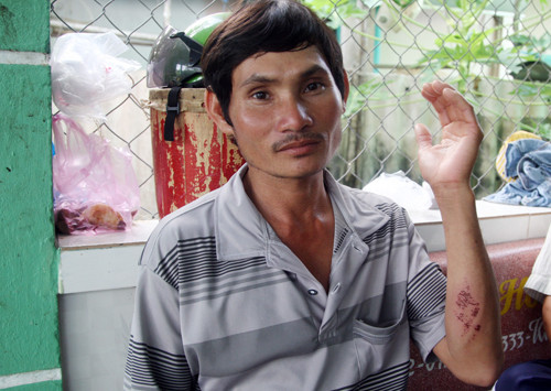 Vết trầy xước trên tay của anh Hậu. Ảnh: An Nhơn