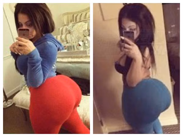 Những biến chứng thẩm mỹ kinh dị nhất nửa đầu năm 2015