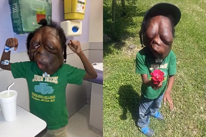 Cậu bé bị gọi là quái vật vì khối u khổng lồ che kín mặt