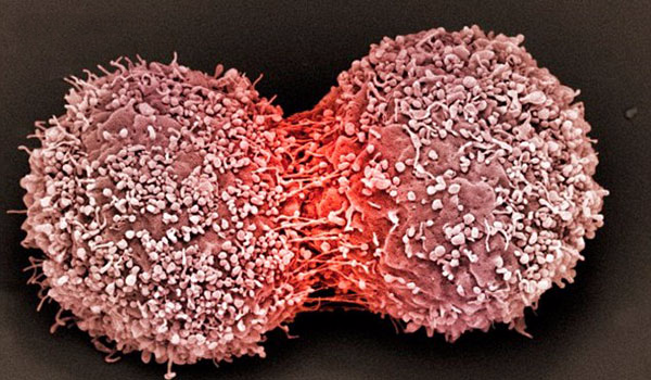 Ai cũng có tế bào ung thư trong người: 3 nguyên tắc vàng chặn đứng sự hình thành khối u ảnh 1 Ai cũng có tế bào ung thư trong người: 3 nguyên tắc vàng chặn đứng sự hình thành khối u ảnh 1