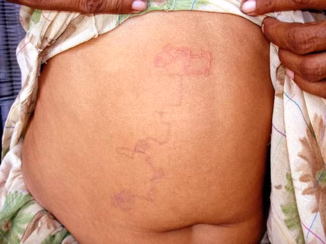 Những ký sinh trùng ngấm ngầm như giun móc rất nguy hiểm Mô tả ảnh.