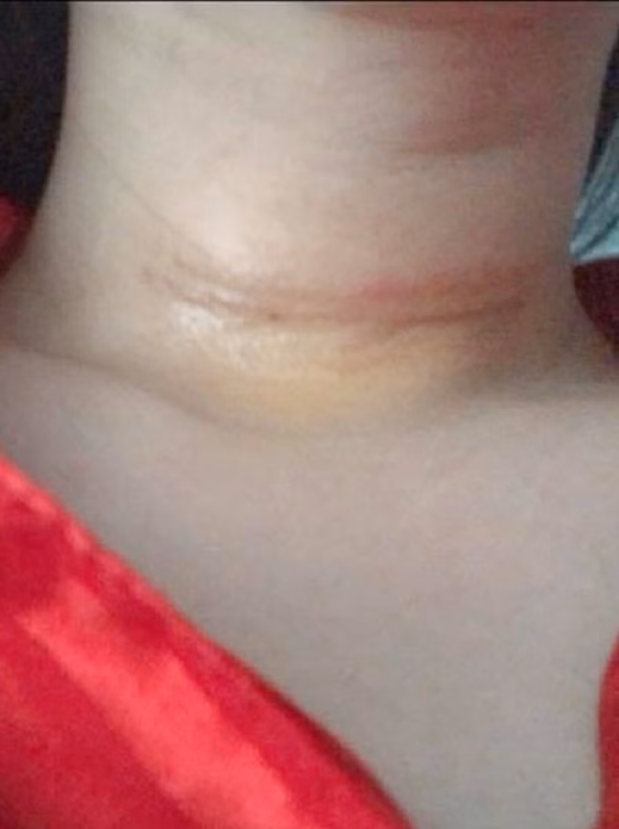 MC Quỳnh Chi đăng tải hình ảnh vừa phẫu thuật xong.