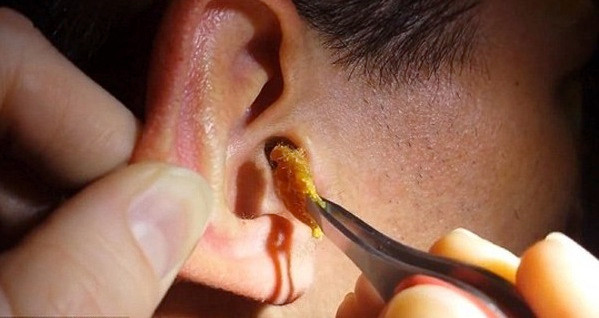 Ngoáy tay bằng vật nhọn có thể gây tổn thương màng nhĩ. Ảnh: David Ngoáy tay bằng vật nhọn có thể gây tổn thương màng nhĩ. Ảnh: David