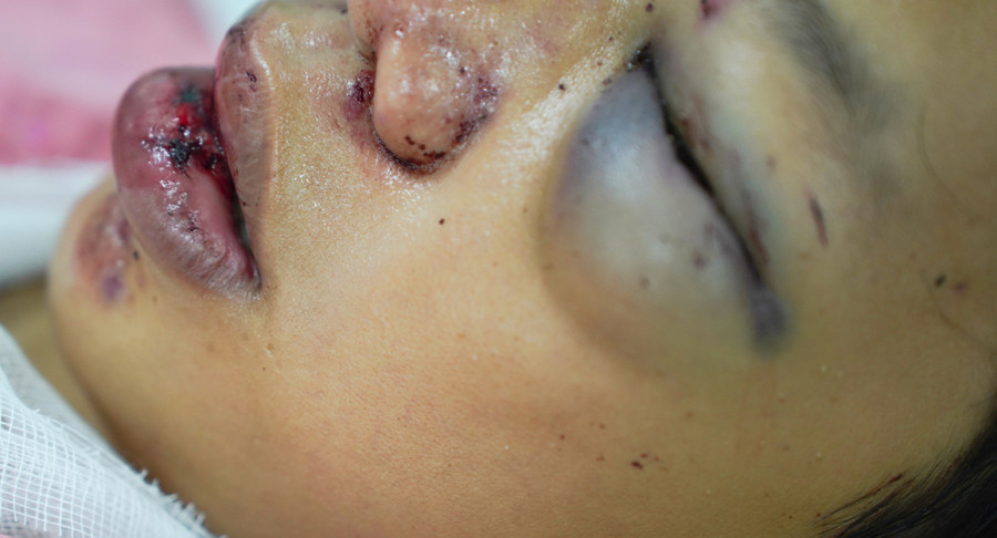 Hiện bệnh nhân đang được theo dõi tri giác, chỉ định chụp CT kịp thời theo từng giai đoạn. (Ảnh: BVCC)