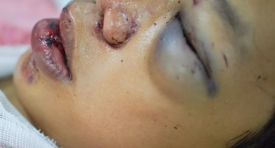 Hiện bệnh nhân đang được theo dõi tri giác, chỉ định chụp CT kịp thời theo từng giai đoạn. (Ảnh: BVCC)