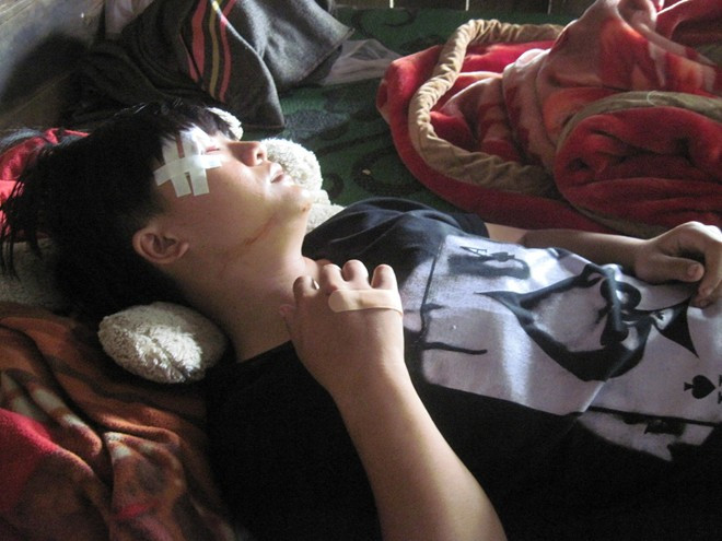 Mắt phải của Phượng bị sưng không thể mở ra được. Mắt phải của Phượng bị sưng không thể mở ra được.