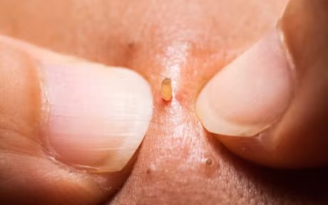 Tat tan tat cac nguyen nhan gay mun chua chac ban da biet het - Anh 1