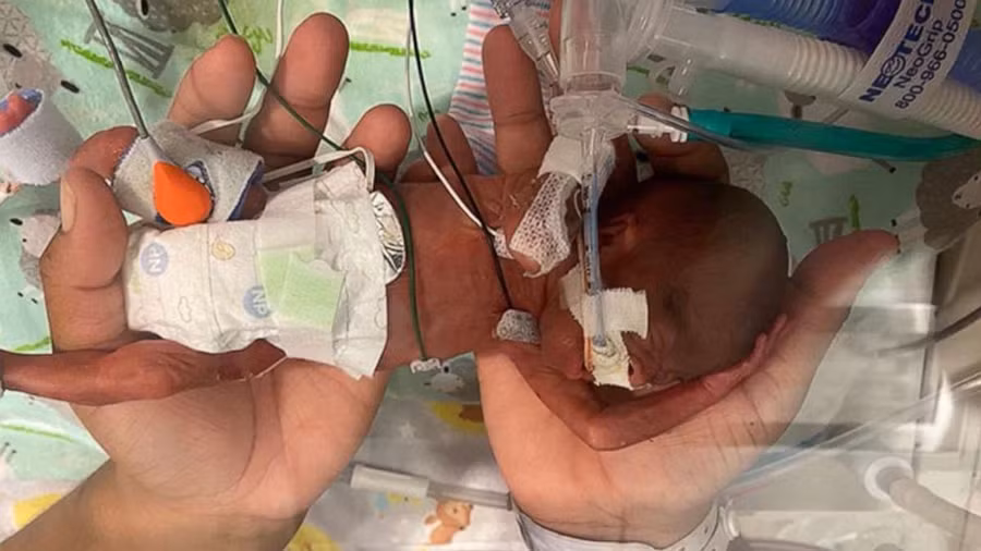 Em bé sinh non nhất thế giới.