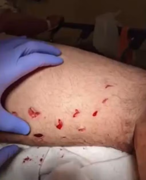 Những vết cắn vào chân khiến người đàn ông này phải đi khập khiễng.