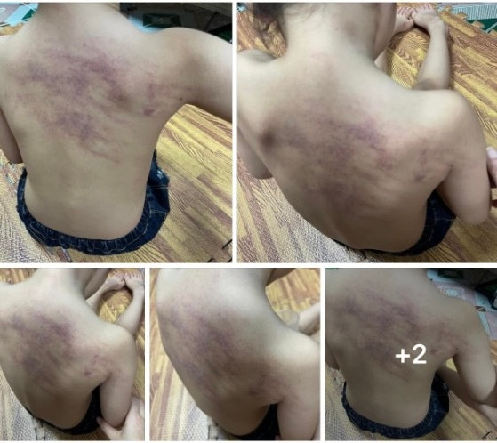 Hình ảnh một trẻ 5 tuổi bị tím vùng lưng được gia đình chia sẻ trên mạng xã hội. Hình ảnh một trẻ 5 tuổi bị tím vùng lưng được gia đình chia sẻ trên mạng xã hội.