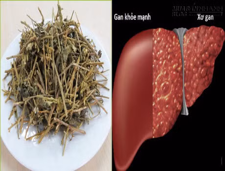 Nguoi viem gan man tinh va xo gan uong cay thuoc nay la khoe ngay - Anh 1