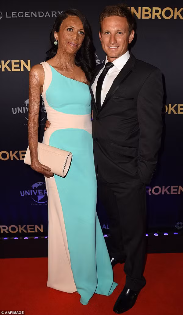 Những hình ảnh mới nhất về chuyện tình của cô gái có khuôn mặt quỷ dữ