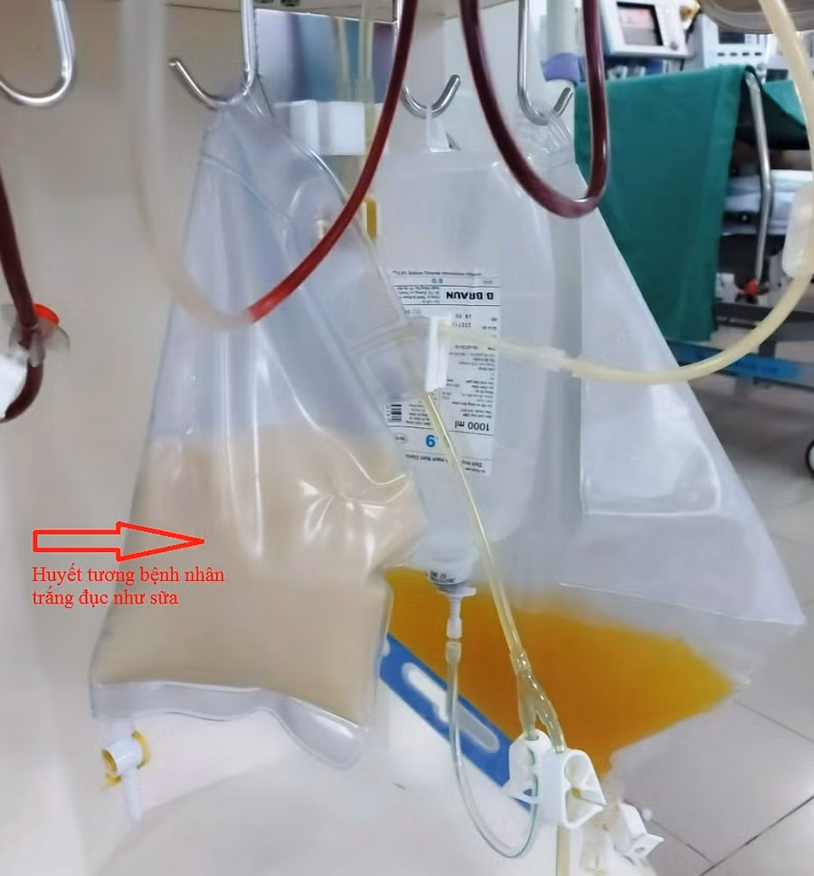 Huyết tương bệnh nhân đục như sữa.