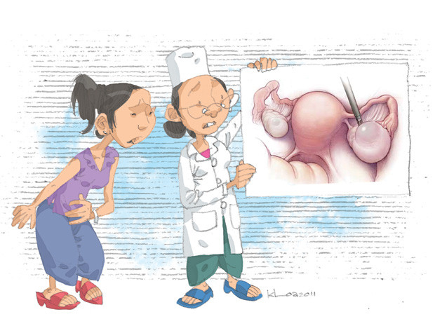 Các loại u nang buồng trứng