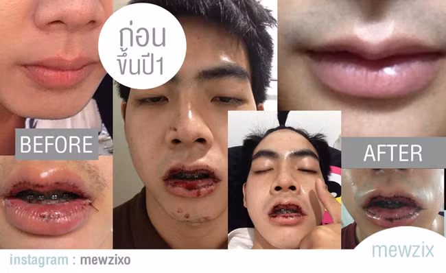 Hot boy Thái Lan khoe ảnh phẫu thuật cả hàm răng gây sốc