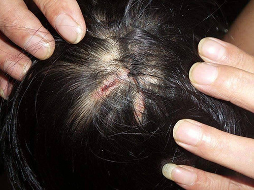 Trên đỉnh đầu bé gái có nhiều vết sẹo, có vết đã khô lại và có vết vẫn còn dính máu. Ảnh: Sơn Dương nghi-van-be-gai-bi-nhot-3-ngay-chi-duoc-an-com-voi-muoi-trang-1