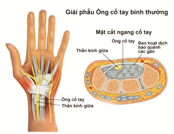 Những điều cần biết về hội chứng ống cổ tay