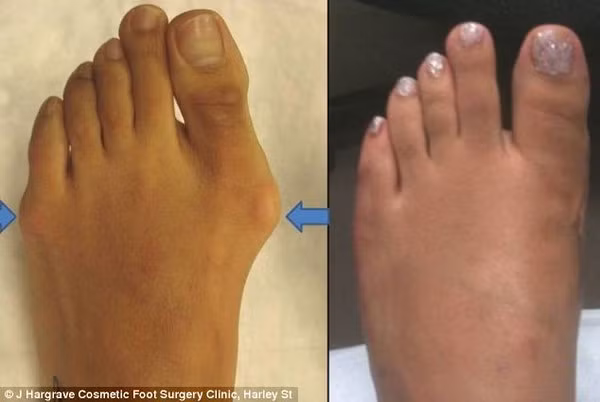 Bi kịch những đôi chân túa máu vì giày cao gót khiến chị em phát sợ ảnh 5