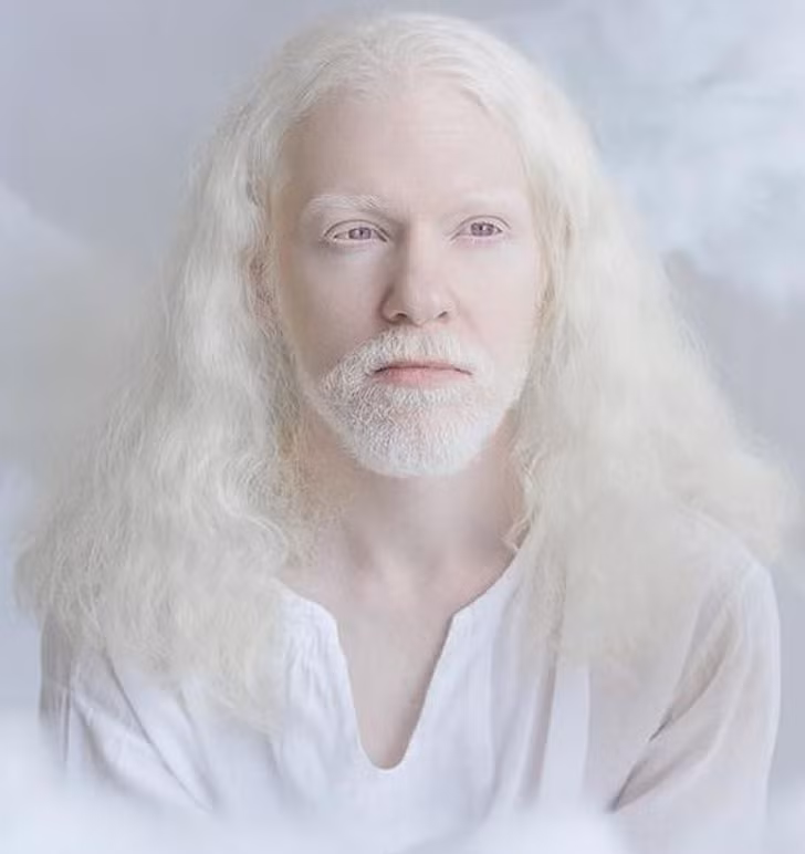 Vẻ đẹp khác lạ của những người mắc bệnh bạch tạng ảnh 8