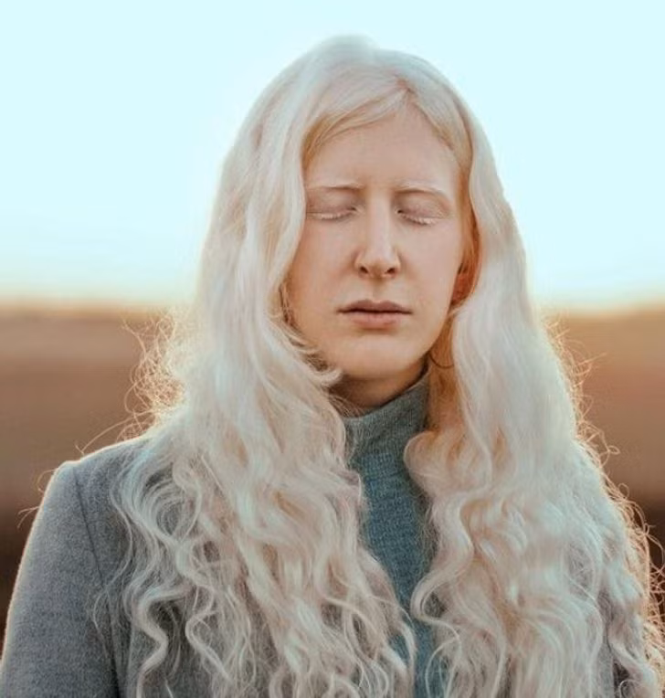 Vẻ đẹp khác lạ của những người mắc bệnh bạch tạng ảnh 13