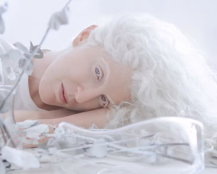 Vẻ đẹp khác lạ của những người mắc bệnh bạch tạng ảnh 4