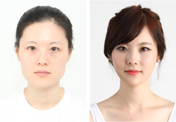 Phẫu thuật thẩm mỹ là chuyện thường và được xã hội chấp nhận: Dù hiện nay việc phẫu thuật thẩm mỹ đã phổ biến hơn, mọi người vẫn không thích công khai. Ở Hàn Quốc, ngược lại, chuyện “dao kéo” được chấp nhận như một phần cuộc sống. Sau khi phẫu thuật, nhiều người được các đồng nghiệp, gia đình và bạn bè khen ngợi, chúc mừng. Hàn Quốc hiện là một trong những địa điểm phẫu thuật thẩm mỹ uy tín và nổi tiếng nhất thế giới. Phẫu thuật thẩm mỹ là chuyện thường và được xã hội đồng tình: Dù hiện nay việc phẫu thuật thẩm mỹ đã phổ biến hơn, mọi người vẫn không thích nói nhiều với đồng nghiệp hay bạn bè nếu có thực hiện. Ở Hàn Quốc thì ngược lại, chuyện “dao kéo” được chấp nhận như một phần cuộc sống. Sau khi phẫu thuật, nhiều người được các đồng nghiệp, gia đình và bạn bè khen ngợi, chúc mừng. Hàn Quốc hiện là một trong những địa điểm phẫu thuật thẩm mỹ uy tín và nổi tiếng nhất thế giới.