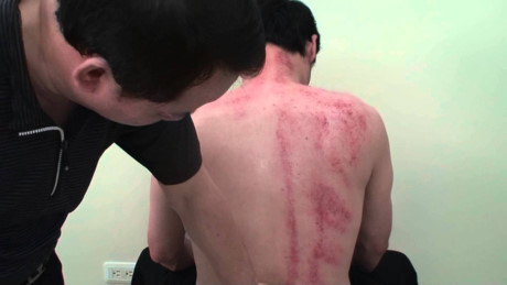 Chồng qua đời sau khi được vợ cạo gió - Ảnh 1 Chong qua doi sau khi duoc vo cao gio - Anh 1