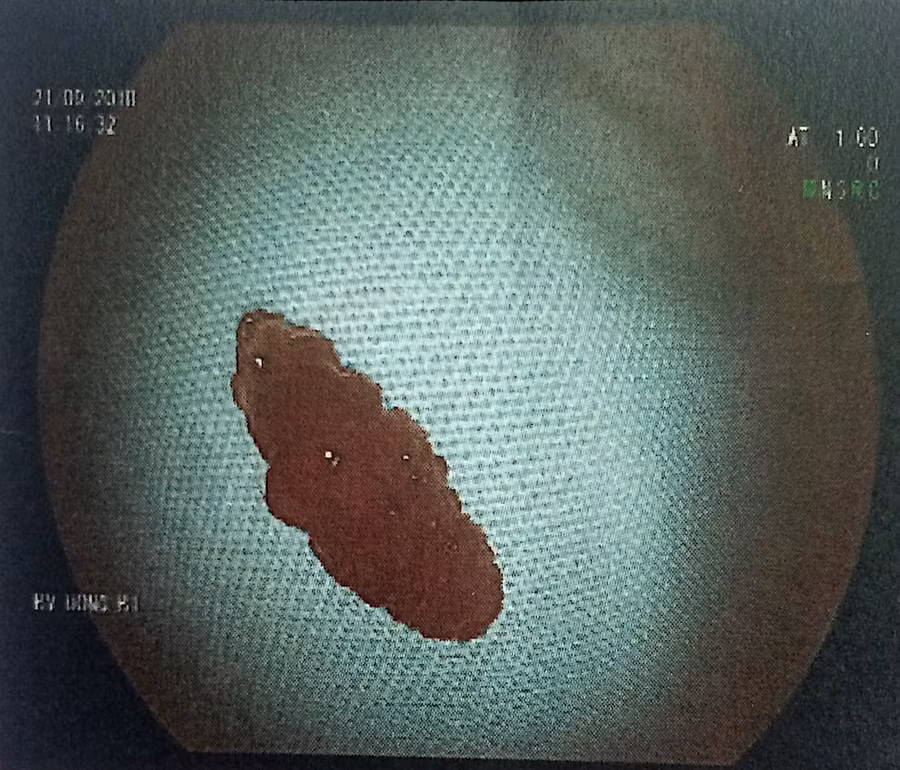 Con sán trong dạ dày người bệnh