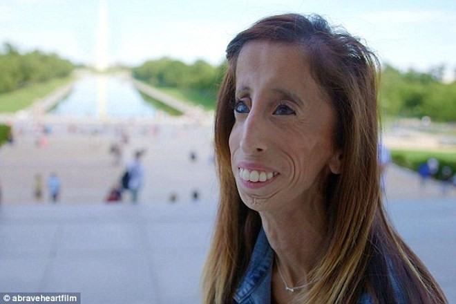 Lizzie Velasquez – „cô gái xấu xí nhất thế giới“. Nguôn Dailymail