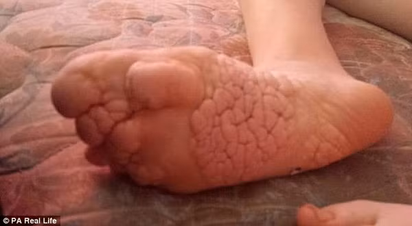 bệnh người voi