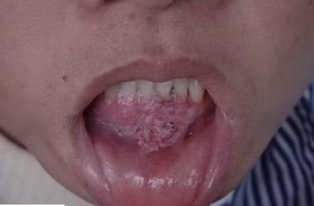 Dùng chung bàn chải đánh răng, rước thêm sùi mào gà ảnh 1