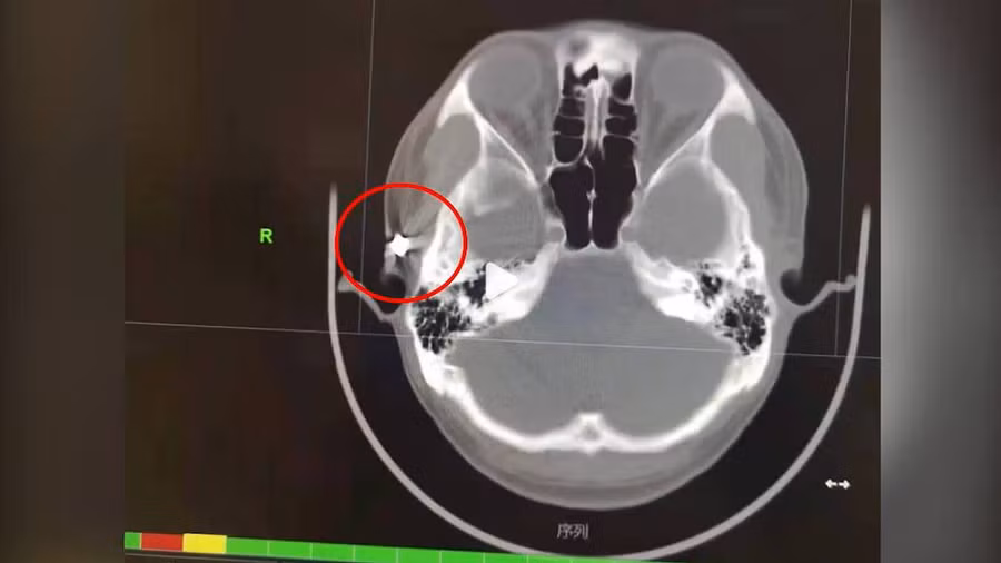 Viên đạn găm vào đầu người đàn ông suốt 20 năm.