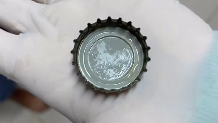 Nắp chai bia được các bác sĩ Bệnh viện Đa khoa Sóc Trăng gắp ra từ bụng ông T.