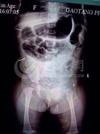 Những bé sơ sinh kỳ lạ khiến y học thế giới kinh ngạc ảnh 7 Những bé sơ sinh kỳ lạ khiến y học thế giới kinh ngạc - 7