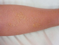 “Tai nạn” kinh hoàng khi dùng kem lột da ảnh 10