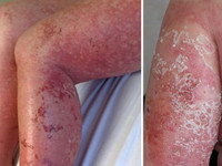 “Tai nạn” kinh hoàng khi dùng kem lột da ảnh 6