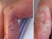 “Tai nạn” kinh hoàng khi dùng kem lột da ảnh 6