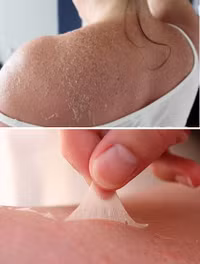 “Tai nạn” kinh hoàng khi dùng kem lột da ảnh 7