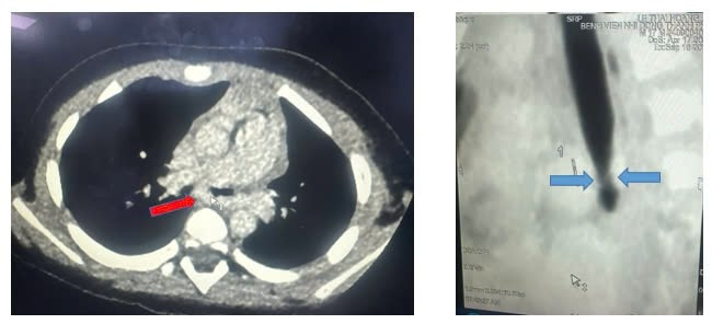CT scan ngực mặt cắt ngang thấy động mạch phổi trái quấn hẹp khí quản gốc, mặt cắt dọc đứng thấy hẹp khí quản gốc (carina).