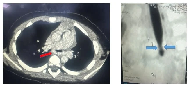 CT scan ngực mặt cắt ngang thấy động mạch phổi trái quấn hẹp khí quản gốc, mặt cắt dọc đứng thấy hẹp khí quản gốc (carina).