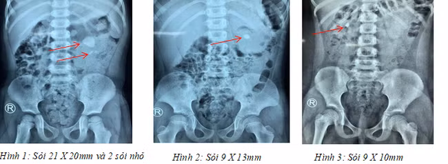Phẫu thuật lấy sạch sỏi thận cho 3 bệnh nhi bằng "đường hầm" siêu nhỏ qua da ảnh 1